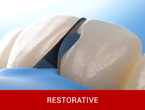 Restoring Anterior Proximal Area with composite